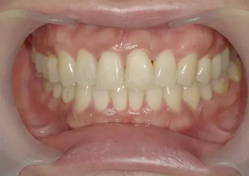 港区青山の歯医者による歯並びの矯正　マウスピース矯正の症例写真で変化を確認　アフター
