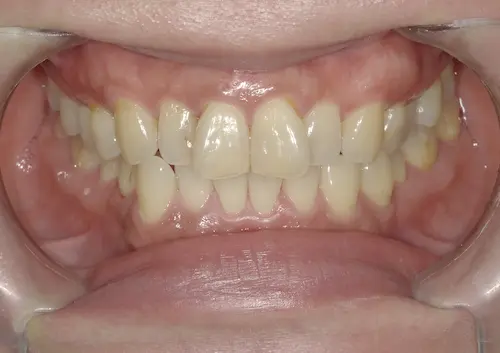 港区青山の歯医者による歯並びの矯正　マウスピース矯正の症例写真で変化を確認　ビフォー